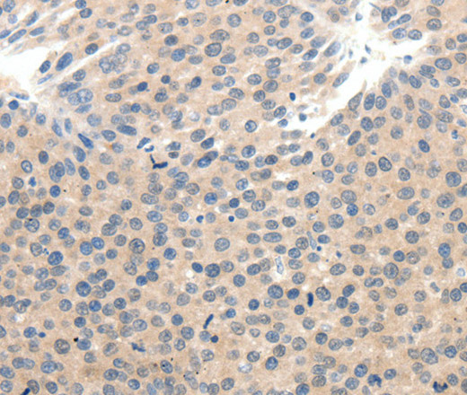 Immunohistochemistry of paraffin-embedded Human breast cancer tissue using SCN10A Polyclonal Antibody at dilution 1:25