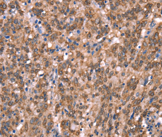 Immunohistochemistry of paraffin-embedded Human gasrtic cancer tissue using GCSAM Polyclonal Antibody at dilution 1:40