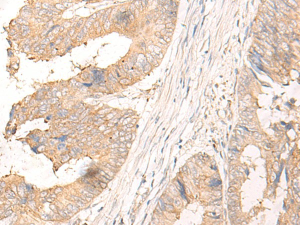 Immunohistochemistry of paraffin-embedded Human colorectal cancer tissue  using MYDGF Polyclonal Antibody at dilution of 1:25(?200)