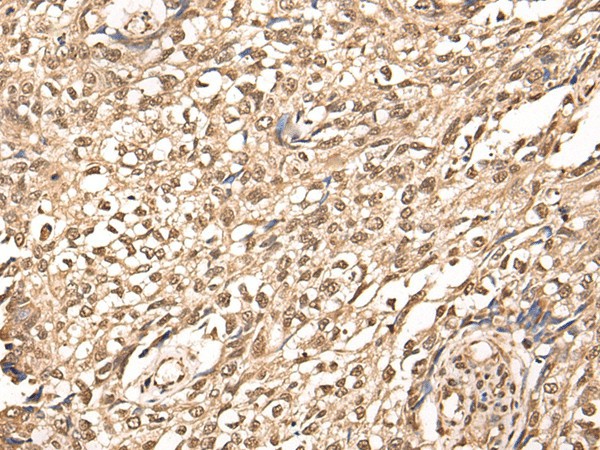 Immunohistochemistry of paraffin-embedded Human lung cancer tissue  using ATAD3A Polyclonal Antibody at dilution of 1:30(?200)