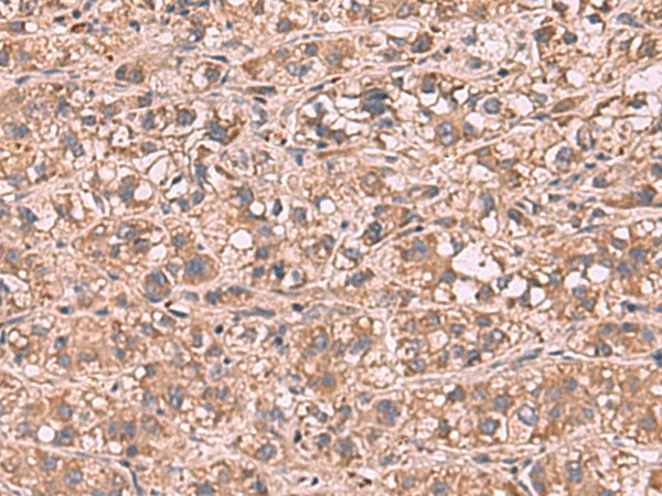 Immunohistochemistry of paraffin-embedded Human liver cancer tissue  using SHC4 Polyclonal Antibody at dilution of 1:90(?200)