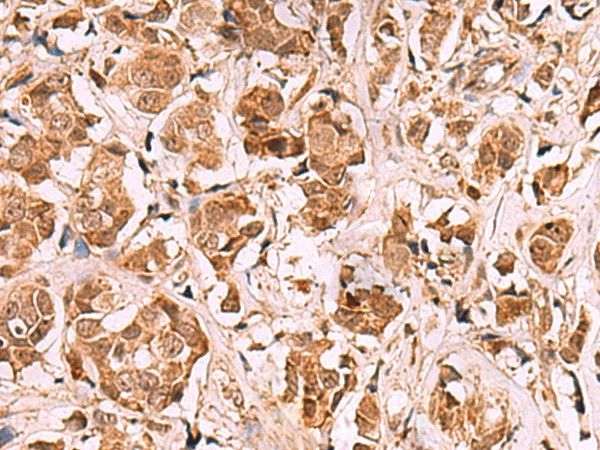 Immunohistochemistry of paraffin-embedded Human breast cancer tissue  using RRP8 Polyclonal Antibody at dilution of 1:80(?200)