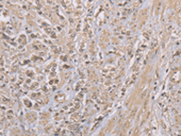 Immunohistochemistry of paraffin-embedded Human prost at e cancer tissue  using ZBTB2  Polyclonal Antibody at dilution of 1:50(?200)