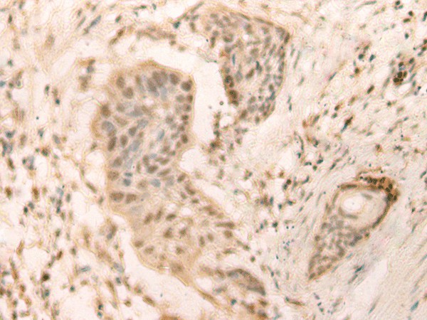 Immunohistochemistry of paraffin-embedded Human esophagus cancer tissue  using ELP4 Polyclonal Antibody at dilution of 1:25(?200)