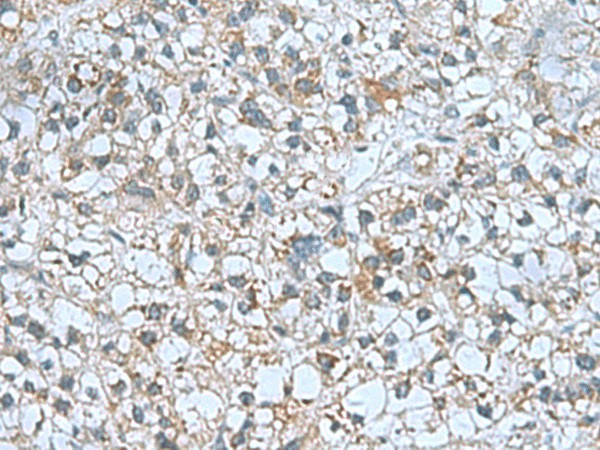 Immunohistochemistry of paraffin-embedded Human liver cancer tissue  using CNTN4 Polyclonal Antibody at dilution of 1:60(?200)