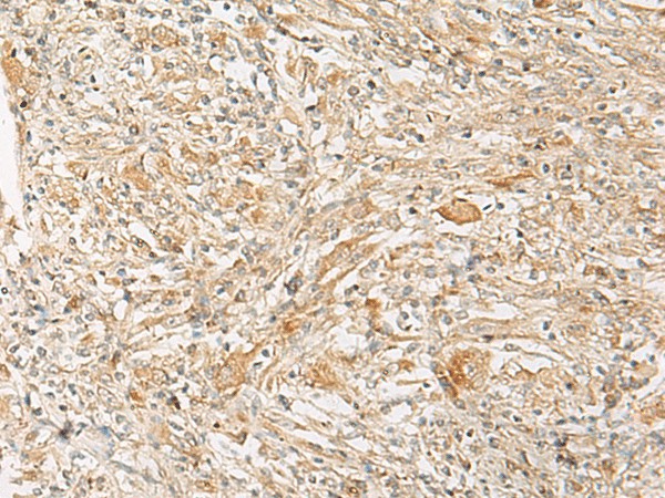 Immunohistochemistry of paraffin-embedded Human liver cancer tissue  using GPR22 Polyclonal Antibody at dilution of 1:50(?200)