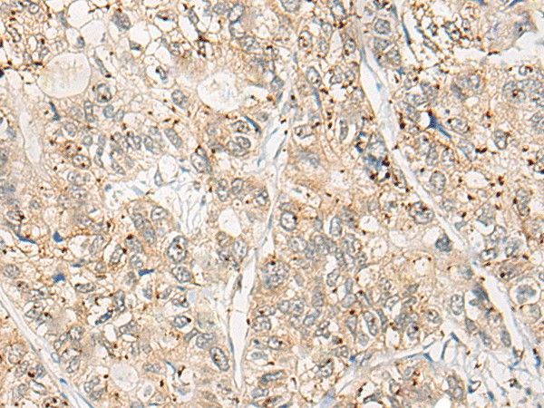 Immunohistochemistry of paraffin-embedded Human gastric cancer tissue  using CPNE4 Polyclonal Antibody at dilution of 1:40(?200)