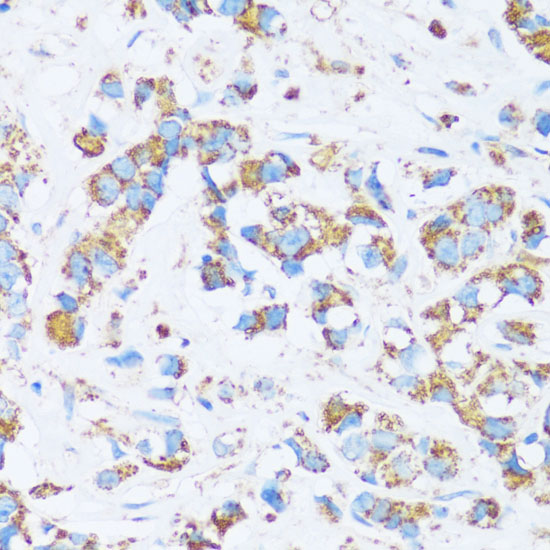 Immunohistochemistry of paraffin-embedded Human breast cancer using CA13 Polyclonal Antibody at dilution of  1:100 (40x lens).