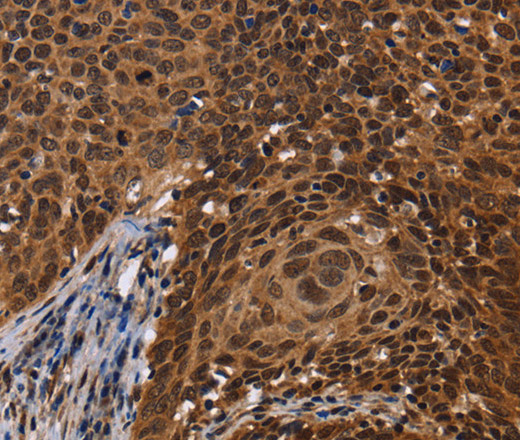 Immunohistochemistry of paraffin-embedded Human cervical cancer tissue using FASTKD5 Polyclonal Antibody at dilution 1:40