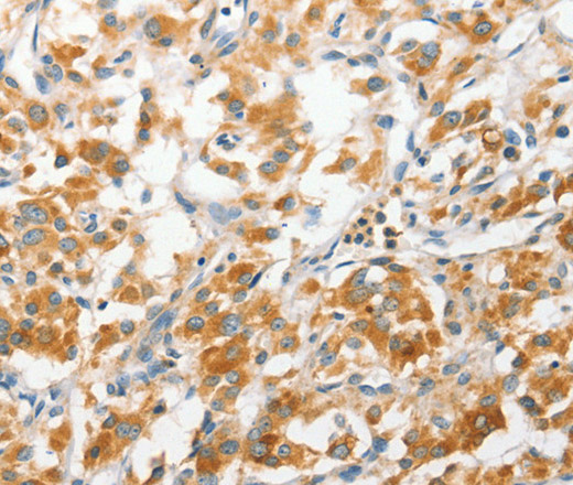 Immunohistochemistry of paraffin-embedded Human thyroid cancer tissue using ANAPC2 Polyclonal Antibody at dilution 1:30