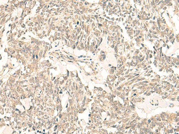 Immunohistochemistry of paraffin-embedded Human lung cancer tissue  using GINS2 Polyclonal Antibody at dilution of 1:50(?200)