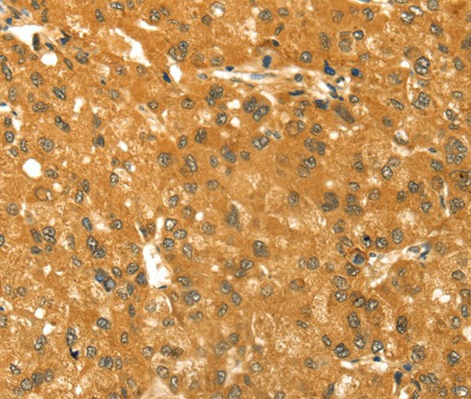 Immunohistochemistry of paraffin-embedded Human liver cancer using TM7SF2 Polyclonal Antibody at dilution of 1:30