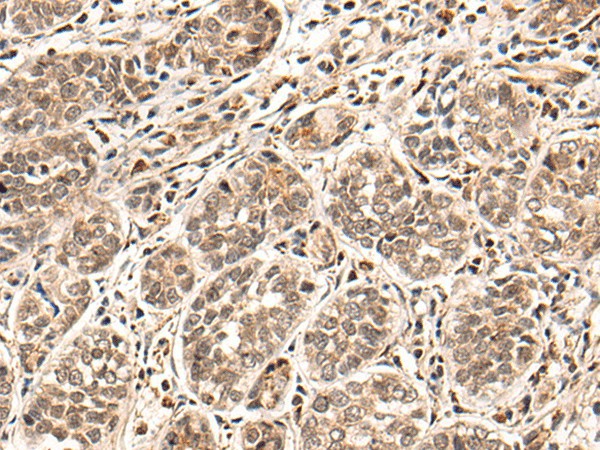 Immunohistochemistry of paraffin-embedded Human esophagus cancer tissue  using HGH1 Polyclonal Antibody at dilution of 1:45(?200)