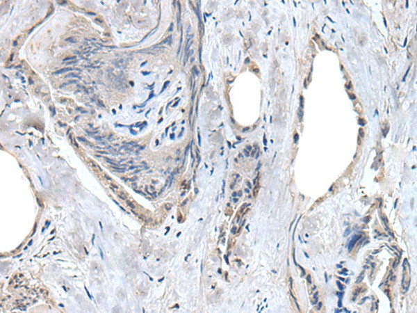 Immunohistochemistry of paraffin-embedded Human thyroid cancer tissue  using RASSF8 Polyclonal Antibody at dilution of 1:55(?200)