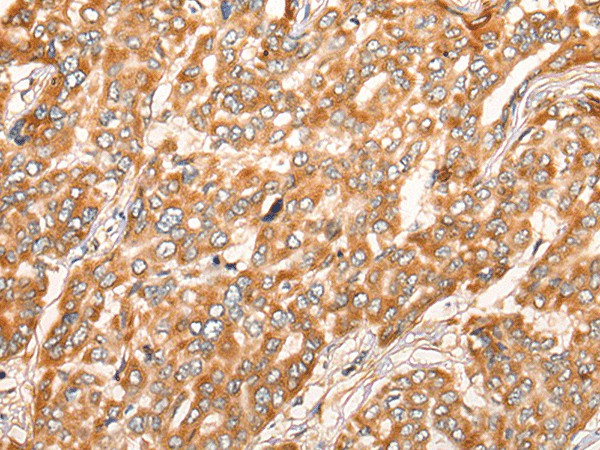 Immunohistochemistry of paraffin-embedded Human liver cancer tissue  using ZMYND10 Polyclonal Antibody at dilution of 1:35(?200)