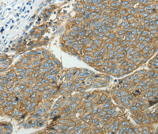 Immunohistochemistry of paraffin-embedded Human liver cancer tissue using SLC16A1 Polyclonal Antibody at dilution 1:50