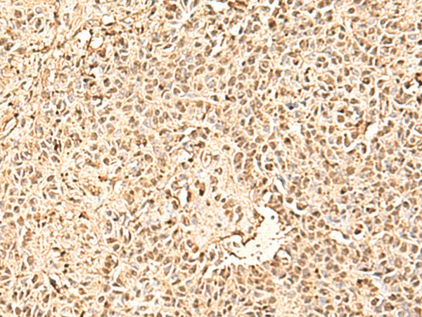 Immunohistochemistry of paraffin-embedded Human ovarian cancer tissue  using SMNDC1 Polyclonal Antibody at dilution of 1:50(?200)