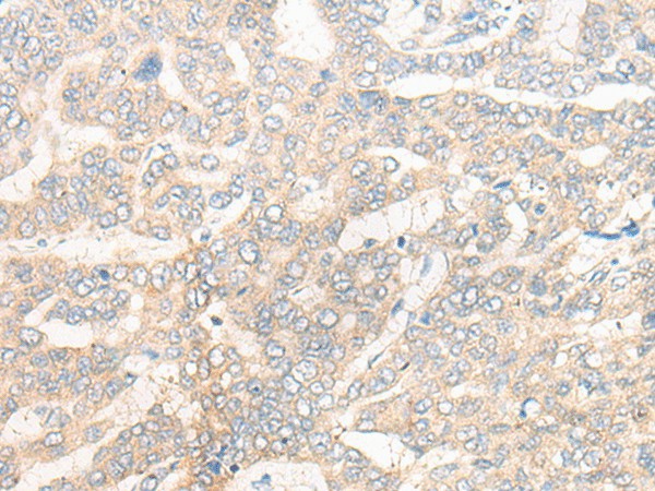 Immunohistochemistry of paraffin-embedded Human liver cancer tissue  using CYB5R3 Polyclonal Antibody at dilution of 1:50(?200)