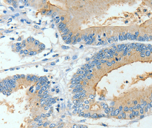 Immunohistochemistry of paraffin-embedded Human colon cancer using BAAT Polyclonal Antibody at dilution of 1:30