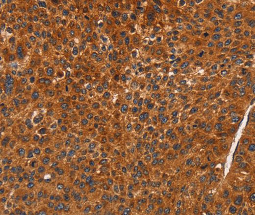 Immunohistochemistry of paraffin-embedded Human liver cancer using CDK19 Polyclonal Antibody at dilution of 1:70