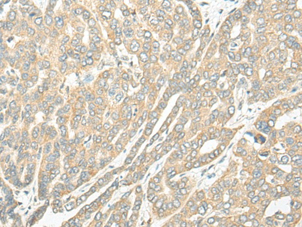 Immunohistochemistry of paraffin-embedded Human liver cancer tissue  using ROM1 Polyclonal Antibody at dilution of 1:25(?200)