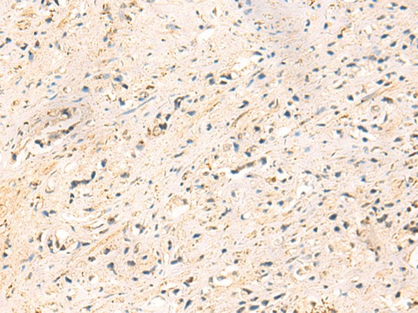 Immunohistochemistry of paraffin-embedded Human prost at e cancer tissue  using IP6K3 Polyclonal Antibody at dilution of 1:50(?200)