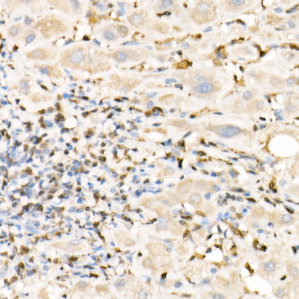 Immunohistochemistry of paraffin-embedded human liver using FSP1/S100A4 Polyclonal Antibody at dilution of 1:100 (40x lens).Perform high pressure antigen retrieval with 10 mM citrate buffer pH 6.0 before commencing with IHC staining protocol.