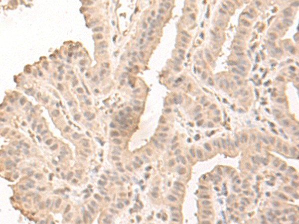 Immunohistochemistry of paraffin-embedded Human thyroid cancer tissue  using SAP130 Polyclonal Antibody at dilution of 1:50(?200)