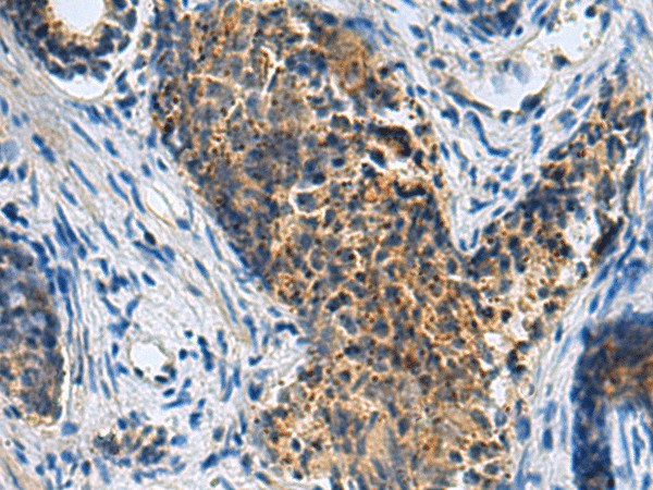 Immunohistochemistry of paraffin-embedded Human prost ate cancer tissue  using PLIN4 Polyclonal Antibody at dilution of 1:50(?200)