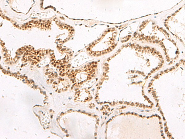 Immunohistochemistry of paraffin-embedded Human thyroid cancer tissue  using DGCR6L Polyclonal Antibody at dilution of 1:65(?200)