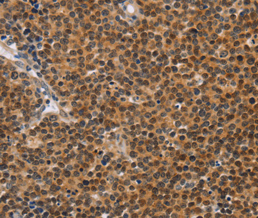 Immunohistochemistry of paraffin-embedded Human Lymphoma tissue using CD36 Polyclonal Antibody at dilution 1:60