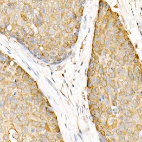 Immunohistochemistry of paraffin-embedded human esophageal cancer using Hsp90β Polyclonal Antibody at dilution of 1:20 (40x lens).Perform high pressure antigen retrieval with 10 mM citrate buffer pH 6.0 before commencing with IHC staining protocol.