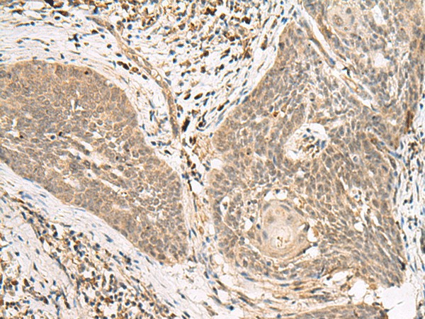 Immunohistochemistry of paraffin-embedded Human esophagus cancer tissue  using LGALSL Polyclonal Antibody at dilution of 1:25(?200)