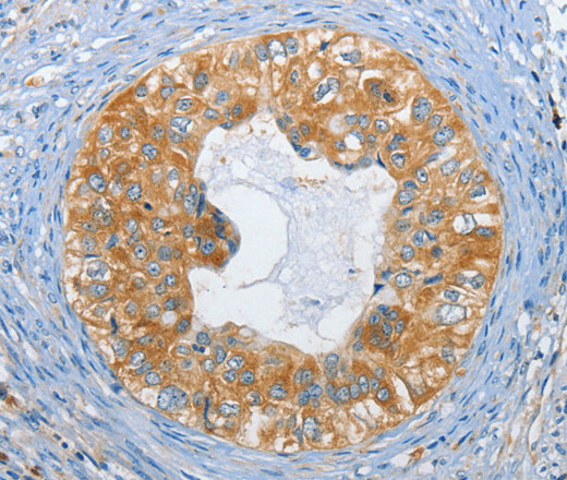 Immunohistochemistry of paraffin-embedded Human cervical cancer tissue using DGK zeta Polyclonal Antibody at dilution 1:60