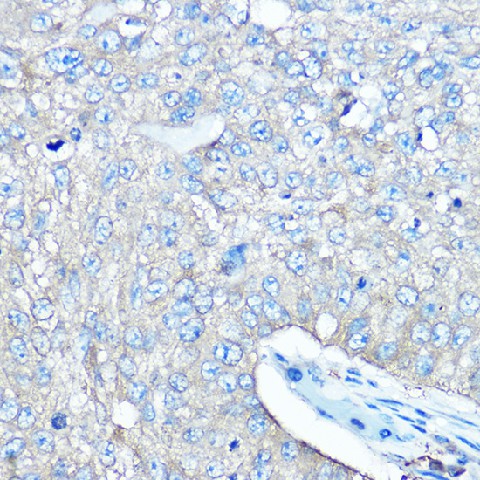 Immunohistochemistry of paraffin-embedded human lung cancer using SARS Polyclonal antibody at dilution of 1:100 (40x lens).Perform high pressure antigen retrieval with 10 mM citrate buffer pH 6.0 before commencing with IHC staining protocol.