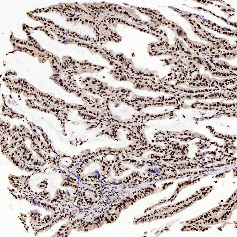 Immunohistochemistry analysis of paraffin-embedded human stomach cancer  using c-Fos Polyclonal Antibody at dilution of 1:200.