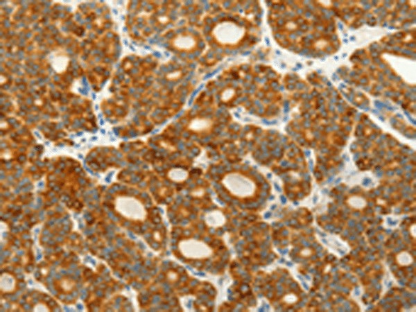 Immunohistochemistry of paraffin-embedded Human thyroid cancer tissue  using VEGFB Polyclonal Antibody at dilution of 1:25(?200)