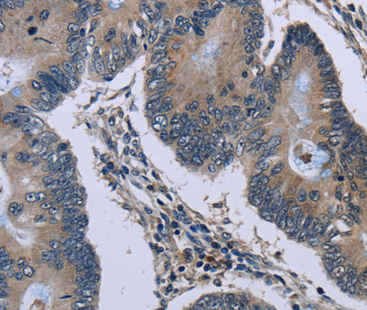 Immunohistochemistry of paraffin-embedded Human colon cancer tissue using Connexin 47 Polyclonal Antibody at dilution 1:40