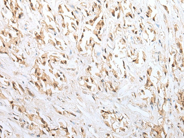 Immunohistochemistry of paraffin-embedded Human prost ate cancer tissue  using ZNF34 Polyclonal Antibody at dilution of 1:40(?200)