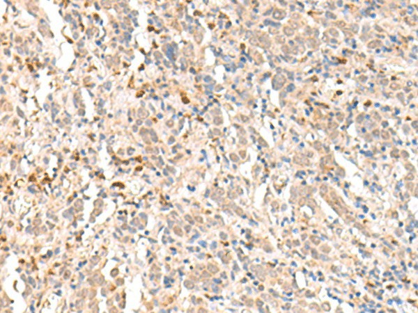 Immunohistochemistry of paraffin-embedded Human cervical cancer tissue  using RBM19 Polyclonal Antibody at dilution of 1:30(?200)