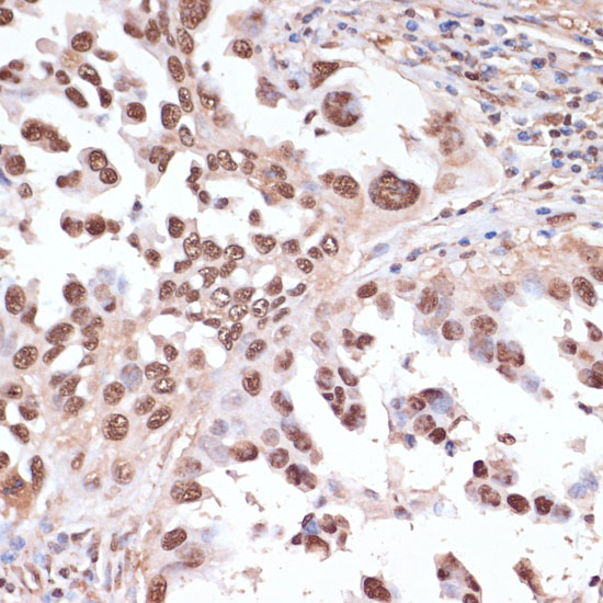 Immunohistochemistry of paraffin-embedded human lung cancer using ITCH Polyclonal Antibody at dilution of 1:100 (40x lens).Perform microwave antigen retrieval with 10 mM PBS buffer pH 7.2 before commencing with IHC staining protocol.