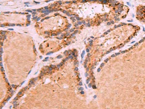 Immunohistochemistry of paraffin-embedded Human thyroid cancer tissue  using GPC2 Polyclonal Antibody at dilution of 1:35(?200)