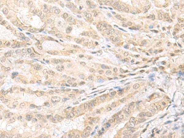 Immunohistochemistry of paraffin-embedded Human thyroid cancer tissue  using EMX1 Polyclonal Antibody at dilution of 1:25(?200)