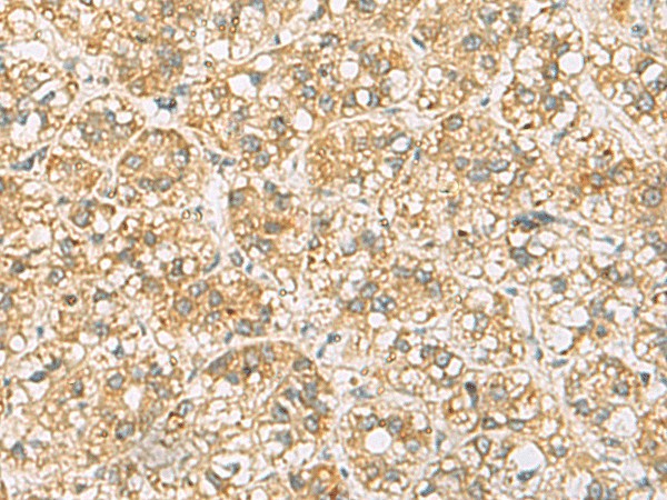 Immunohistochemistry of paraffin-embedded Human liver cancer tissue  using FAAP100 Polyclonal Antibody at dilution of 1:65(?200)