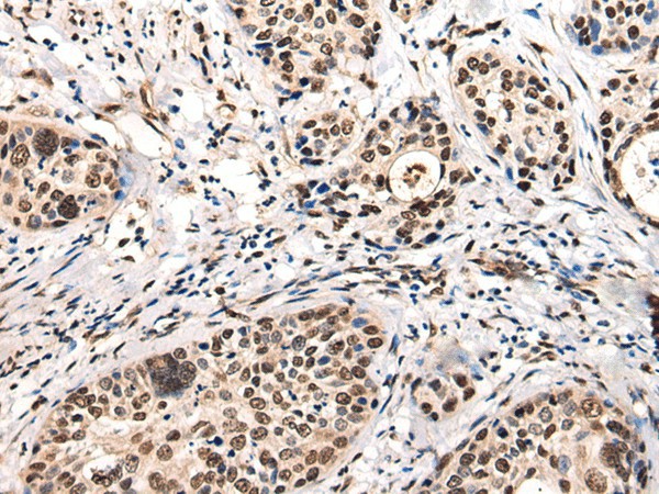 Immunohistochemistry of paraffin-embedded Human cervical cancer tissue  using USP6NL Polyclonal Antibody at dilution of 1:30(?200)