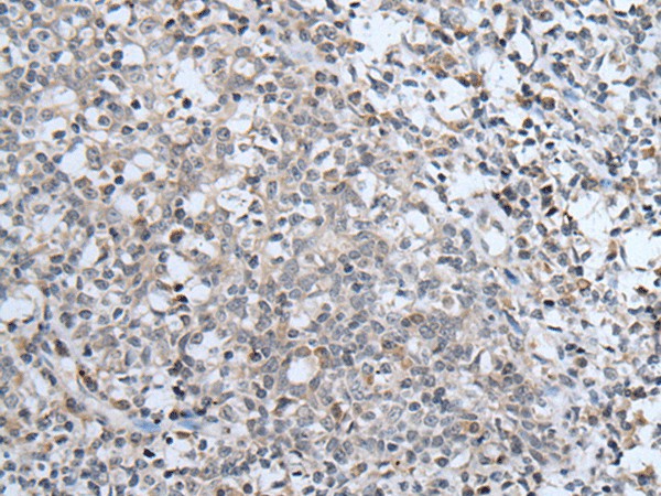 Immunohistochemistry of paraffin-embedded Human tonsil tissue  using ABCA6 Polyclonal Antibody at dilution of 1:40(?200)