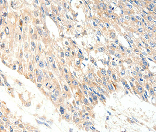 Immunohistochemistry of paraffin-embedded Human esophagus cancer tissue using SLC27A1 Polyclonal Antibody at dilution 1:40