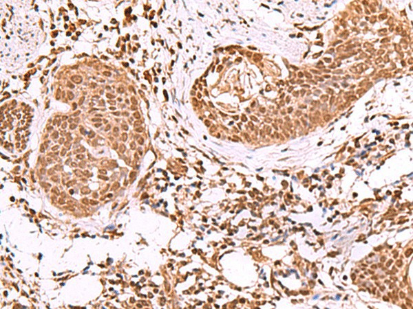 Immunohistochemistry of paraffin-embedded Human esophagus cancer tissue  using IP6K1 Polyclonal Antibody at dilution of 1:55(?200)