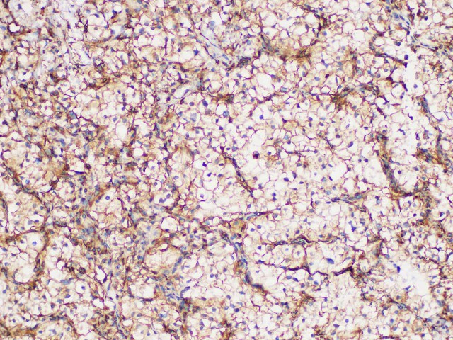 Immunohistochemistry of paraffin-embedded Human renal clear cell carcinoma using GPNMB Polycloanl Antibody at dilution of 1:200.