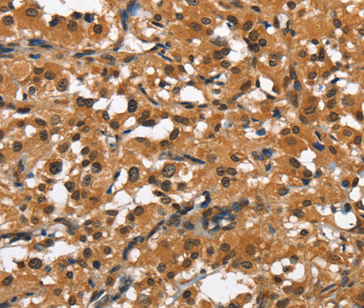 Immunohistochemistry of paraffin-embedded Human thyroid cancer tissue using SLAMF8 Polyclonal Antibody at dilution 1:50